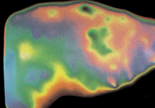 edema II